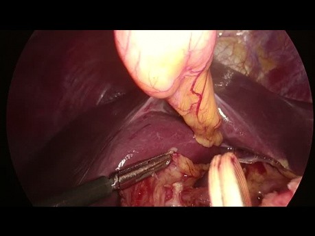 Laparoscopic RAMPS (Radical Antegrade Modular Pancreatosplenectomy) with Portal Vein Resection