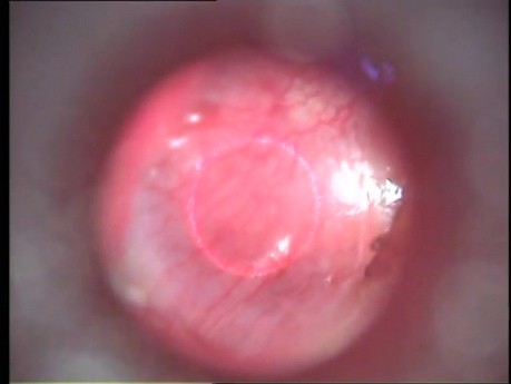 Myringotomy - Laser Method