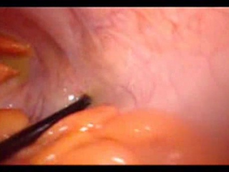 Colonic Perforation With Peritonitis - Laparoscopy (30 of 46)
