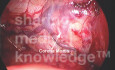 Laparoscopic Groin Anotomy (Corona Mortis)
