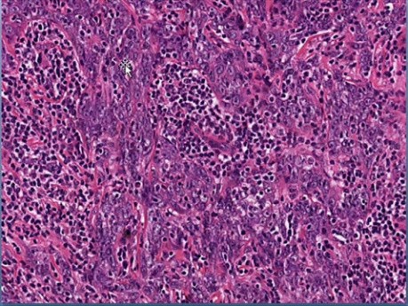 Neoplasia - MSP - 7b