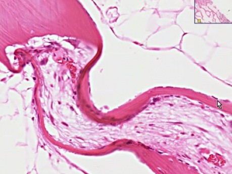 Hyperparathyroidism - Histopathology - Bone