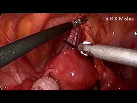 Laparoscopic Oophoropexy for Recurrent Adnexal Torsion