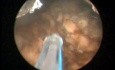 Greenlight HPS - Prostate After Brachytherapy