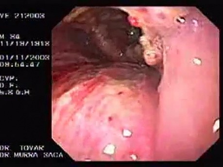  Extensive carcinoma that invades larynx, epiglottis and base of the tongue (1 of 2)