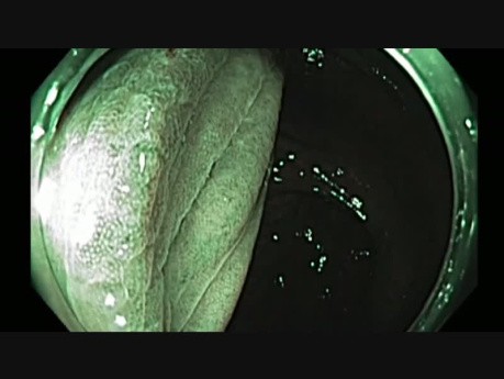 Colonoscopy - EMR Scar evaluation