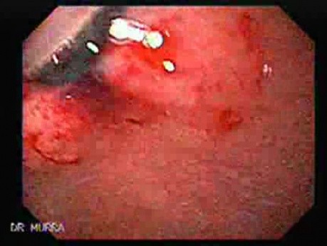 Hyperplastic Polyps - Endoscopy (11 of 14)