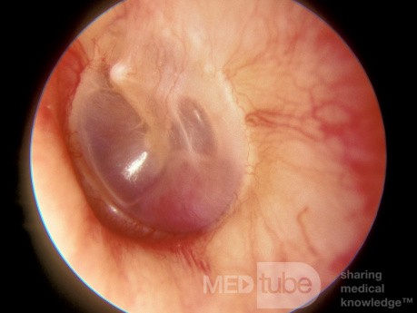 Glomus Jugulare Tumor