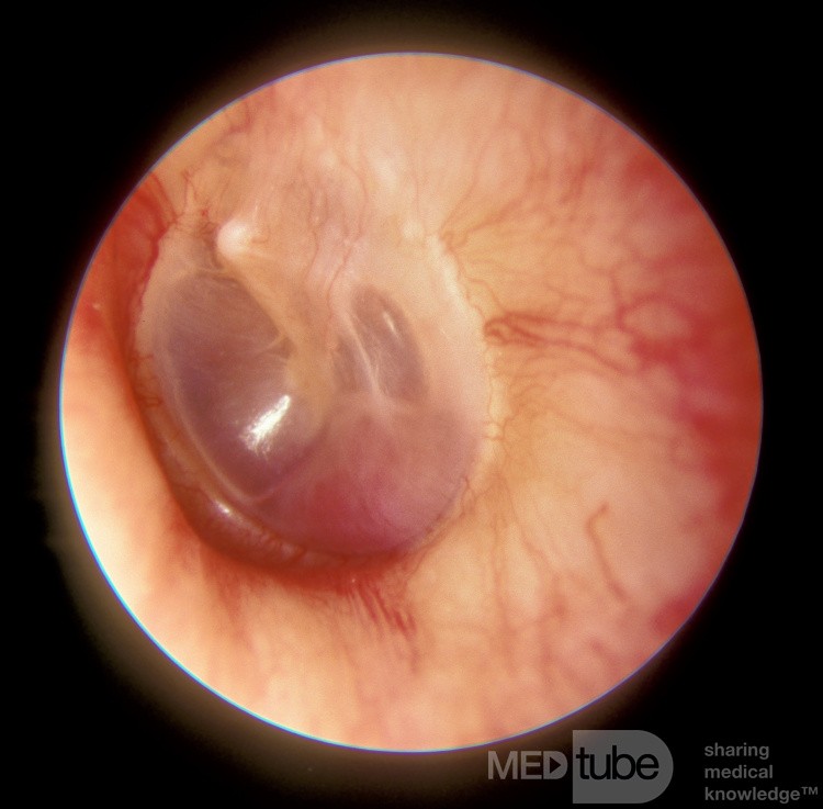 Glomus Jugulare Tumor