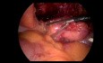Urachal-Tumor Cutting Laparoscopic Surgery