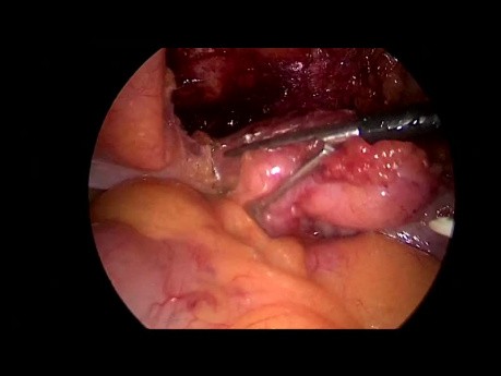 Urachal-Tumor Cutting Laparoscopic Surgery