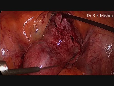 Laparoscopic Myomectomy