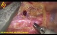 Thoraco-Lap Esophagectomy - Thoracic Part 2