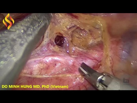 Thoraco-Lap Esophagectomy - Thoracic Part 2