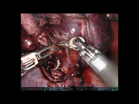 Robotic Right Middle Lobectomy of Lung