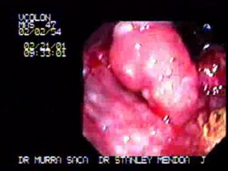 Rectum Adenocarcinoma - Retroflexed Image