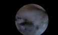 Endoscopic Discectomy with Foraminal Access