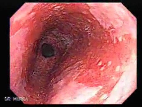 Barrett's Esophagus of long segment (4 of 24)