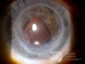 Lens Implantation and DSEK in a Case of Aphakic Bullous Keratopathy