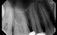 TCA Apical Split