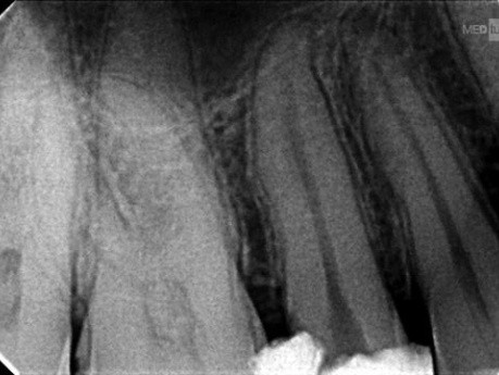 TCA Apical Split
