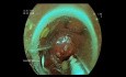 EFTR of Sigmoid Colon Polypectomy Base