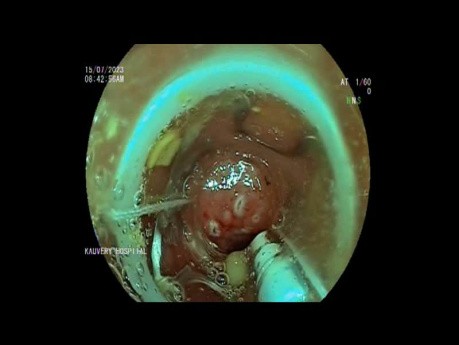 EFTR of Sigmoid Colon Polypectomy Base