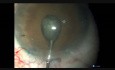 Oval Rhexis is Small Pupil