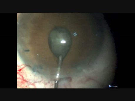 Oval Rhexis is Small Pupil