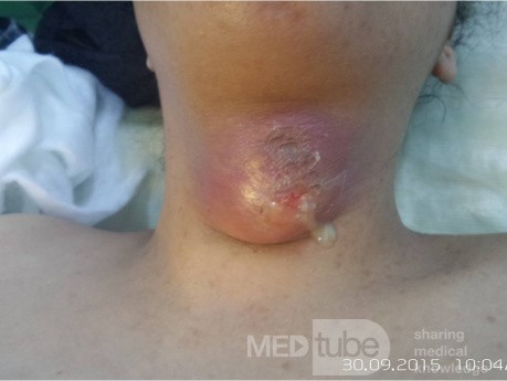 Thyroglossal Abscess 