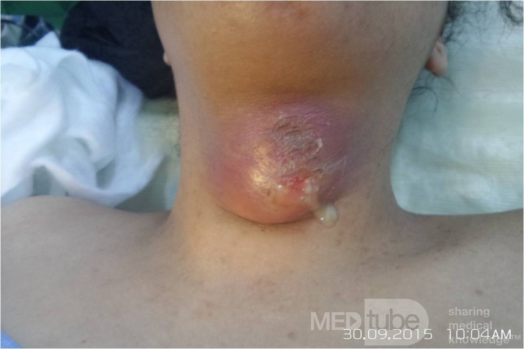 Thyroglossal Abscess 