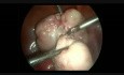 Laparoscopic Ovarian Fibroma