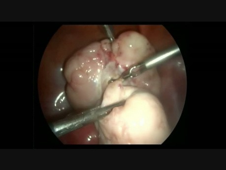 Laparoscopic Ovarian Fibroma