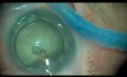 Intumescent Cataract, Phacoemulsiphication