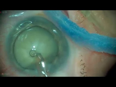 Intumescent Cataract, Phacoemulsiphication