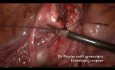 Outpatient Bloodless Myomectomy