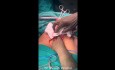 Uterine Inversion Correction