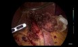 Laparoscopic Hellers Cardiomyotomy + Dor Fundoplication
