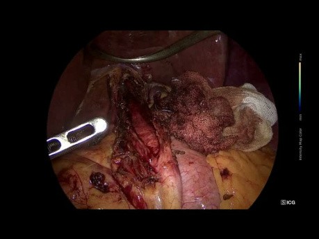 Laparoscopic Hellers Cardiomyotomy + Dor Fundoplication