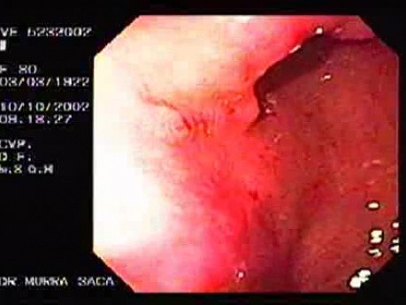Acute Gastritis of the Antrum