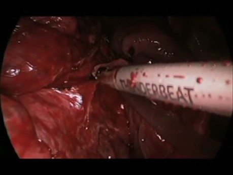 Congenital Cystic Adenomatoid  Malformation (CCAM) Uniportal Lobectomy.