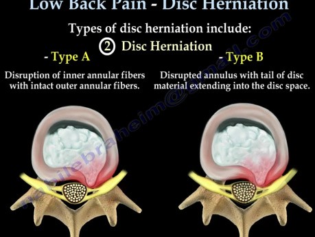 Disc herniation of the lumbo sacral spine