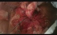 Malignant Parotid Tumor