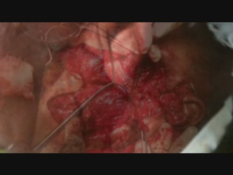 Malignant Parotid Tumor