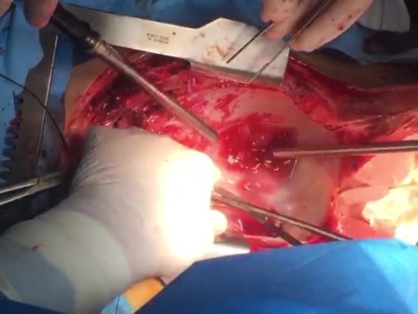 Heart Harvest Technique with first Caval Division and then Pulmonary Veins finally Great Arteries 