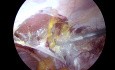 TAPP for Direct Groin Hernia