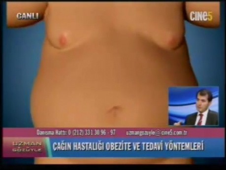 Obesity Treatment