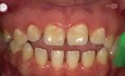 Step by Step Ceramic Braces Bonding (Dentaurum)