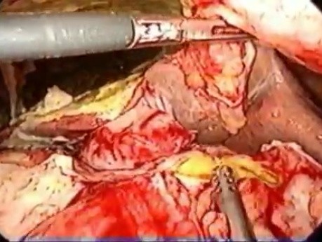 Laparoscopic omental patch repair PPU