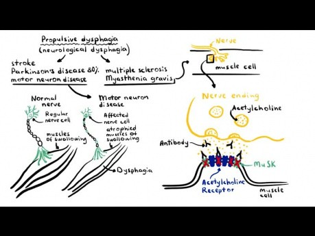Dysphagia (Difficulty Swallowing) - Causes, Pathophysiology, Classification, Investigation